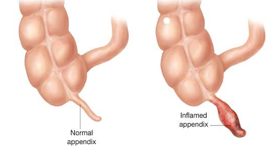Apandisit Nedir