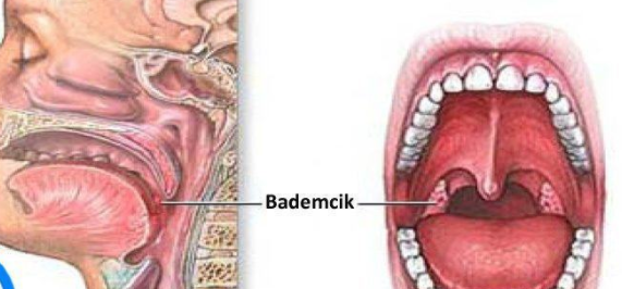 Bademcik İltihabı